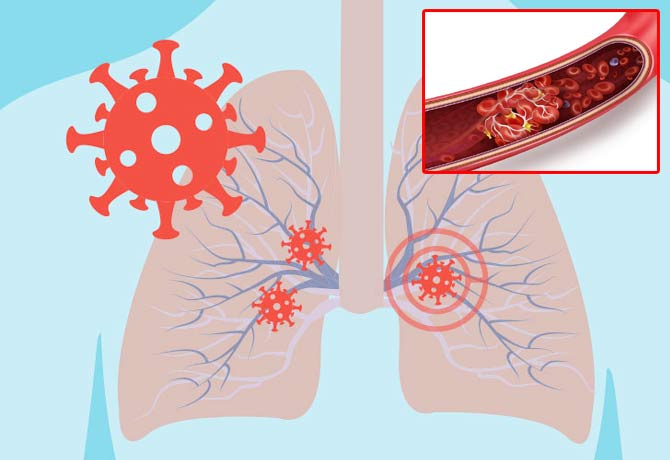 Covid not only damages Lungs, but also blood clots