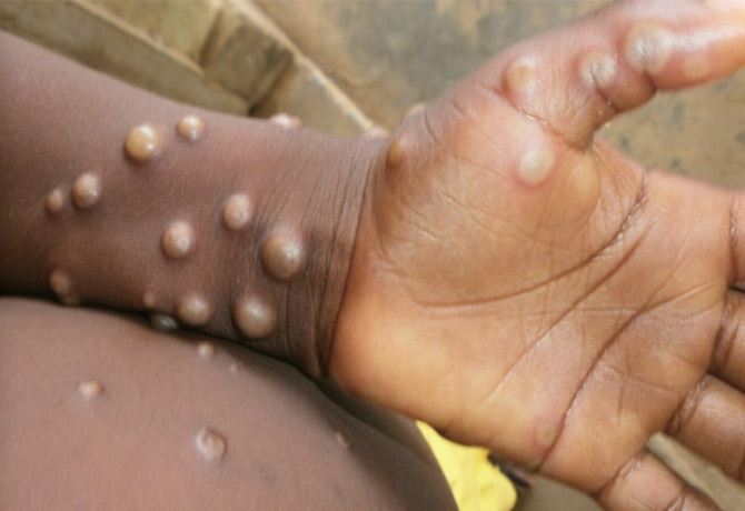 Monkeypox causes encephalitis and damage to nervous system