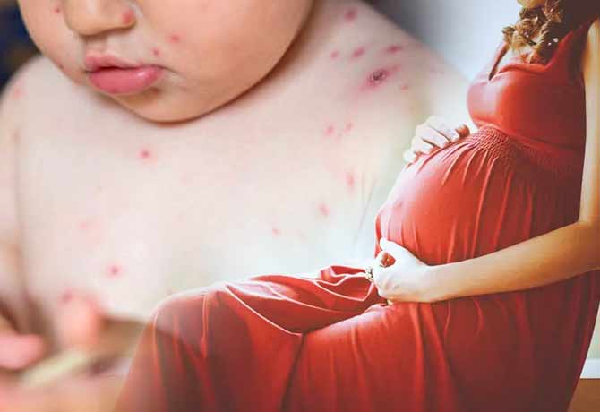 monkeypox effect on children and pregnant womens