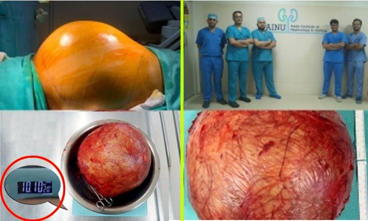 Doctors remove kidney tumor the size of football