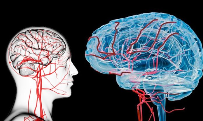 Stroke Risk higher in Young Adults