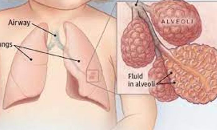 pneumonia-in-childhood