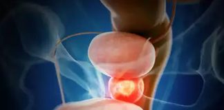 Regular checkups are essential for prostate cancer