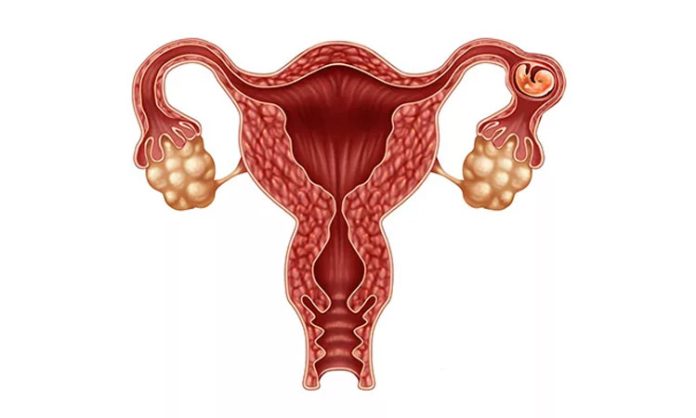 Endometriosis prevention “Dichloroacetate”.. Trials in Britain