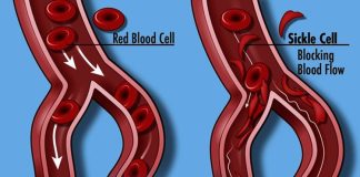 Sickle cell disease in india