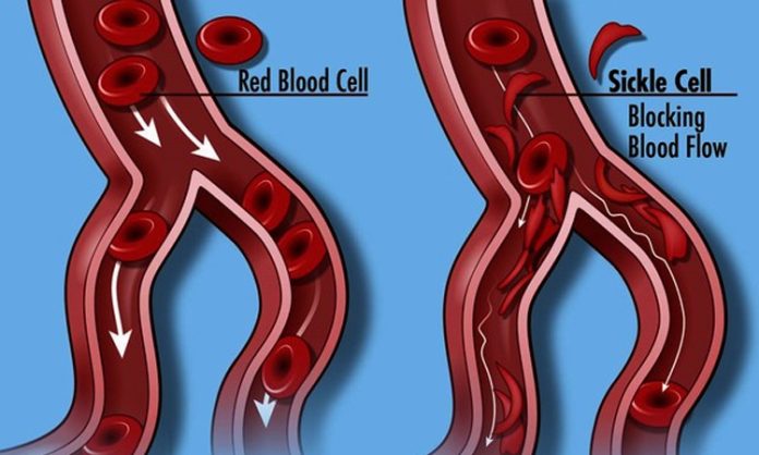 Sickle cell disease in india