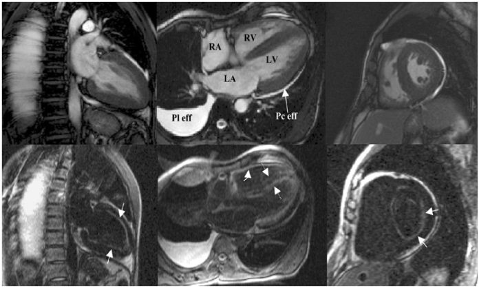 Cardiac amyloidosis