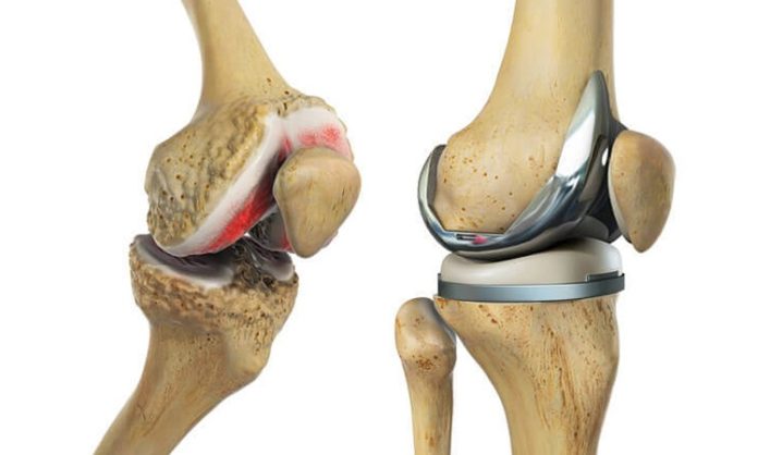 Complications During Knee Replacement Surgery