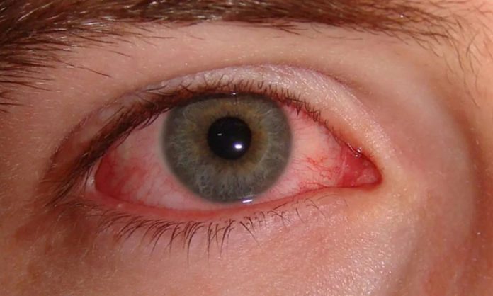 Conjunctivitis problem in summer