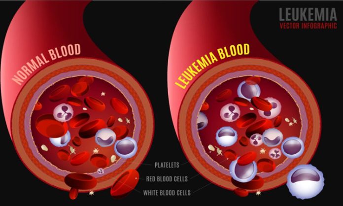 Leukemia blood Cancer