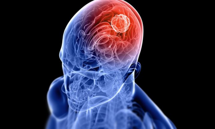 Tumor in brain and spine is fatal