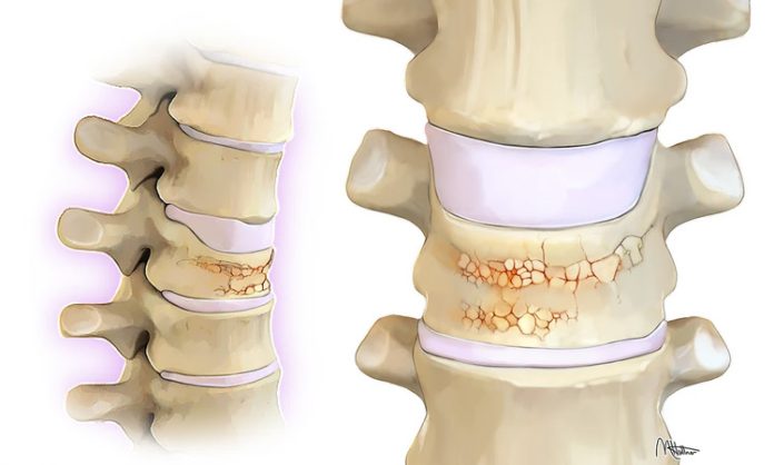 Osteoporosis symptoms