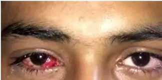 Pink Eye disease problem