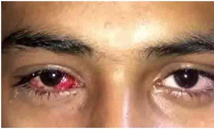 Pink Eye disease problem