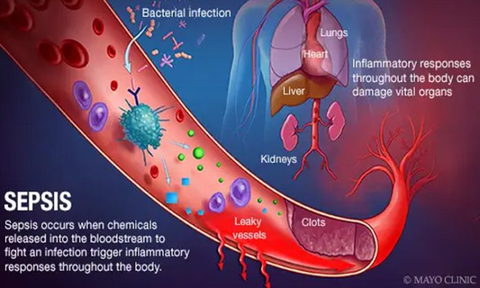 Sepsis treatment