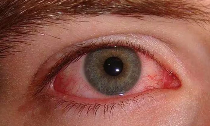 Pink eye infection treatment
