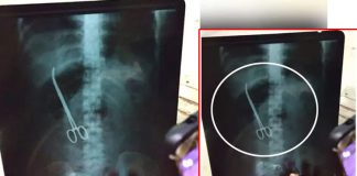 Scissors Left Inside Patient at Eluru Hospital