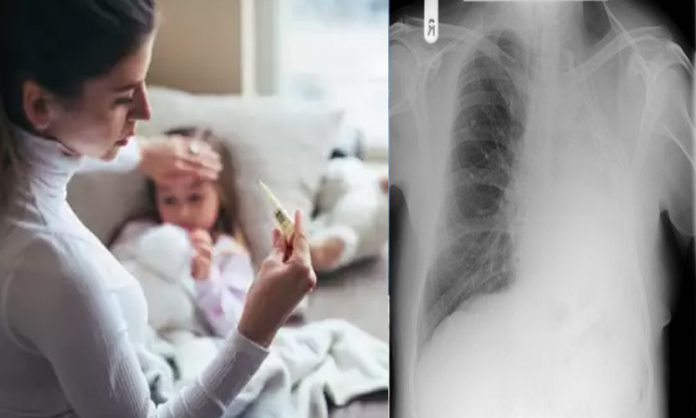 White Lung syndrome life-threatening for children