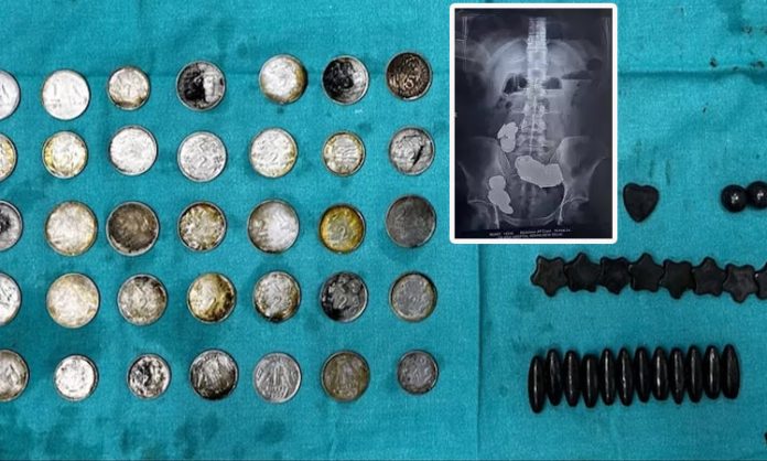 Delhi man swallows 39 coins and 37 magnets