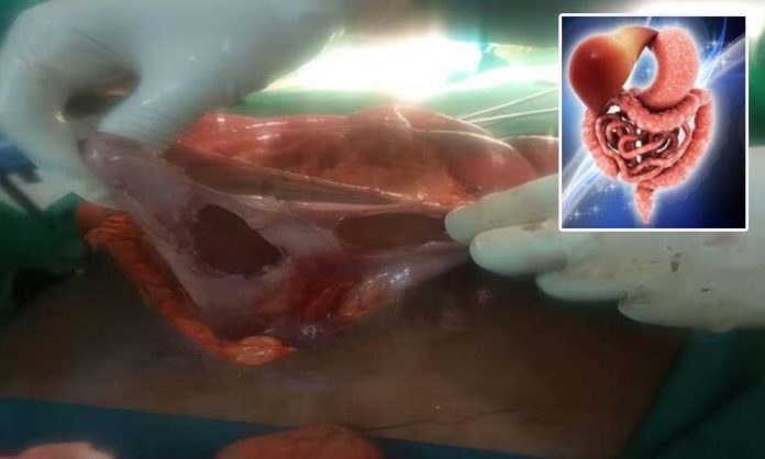 Intestines blast with cough