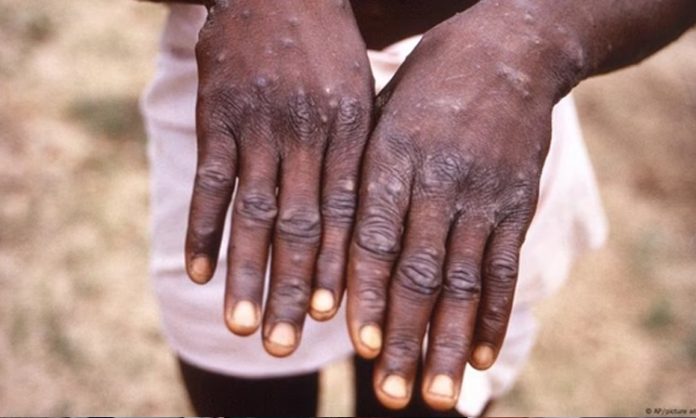 Monkey Pox