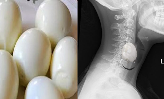 Egg stuck in throat
