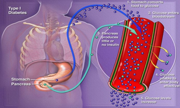 Pancreas cell transfer cure diabetes