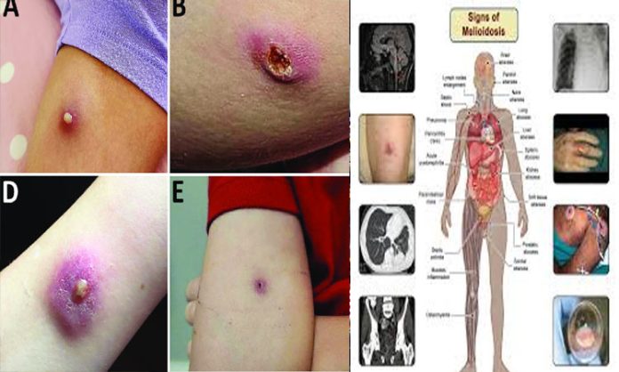 Infection melioidosis