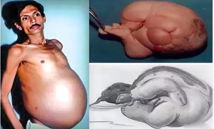 Sanju Bhagat stomach